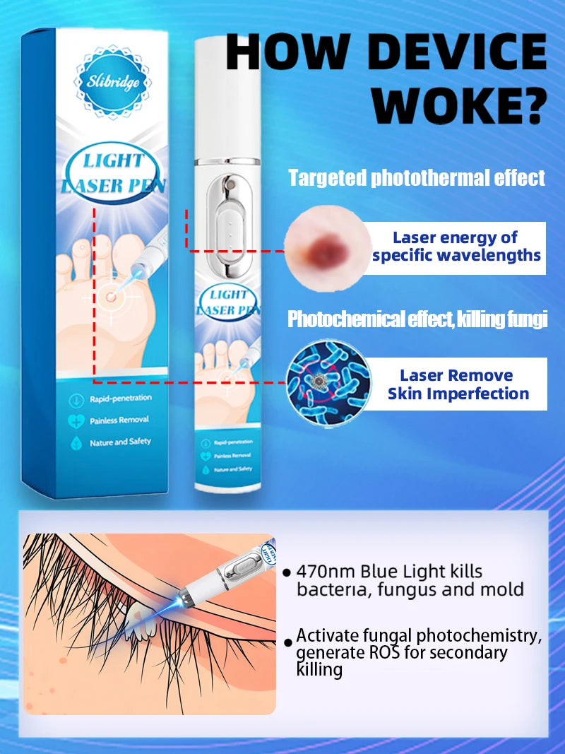 White cylindrical light laser pen for treating fungal skin infections with targeted blue light.