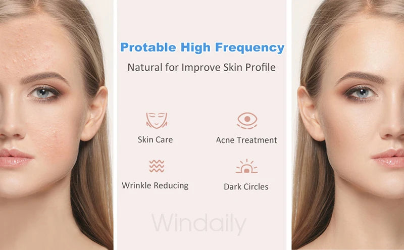 Before and after comparison of a woman’s skin using a high frequency facial device for acne and wrinkle treatment.