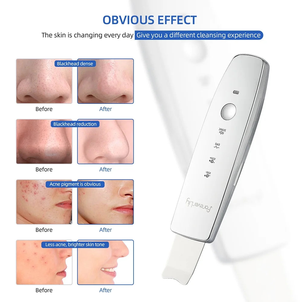 Ultrasonic Facial Skin Scrubber | Professional Deep Cleaning Spatula Scrubs Treatments Tidesmit