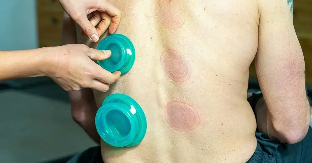 Therapist placing green silicone suction cups on a patient's back, showing circular marks from previous cupping.
