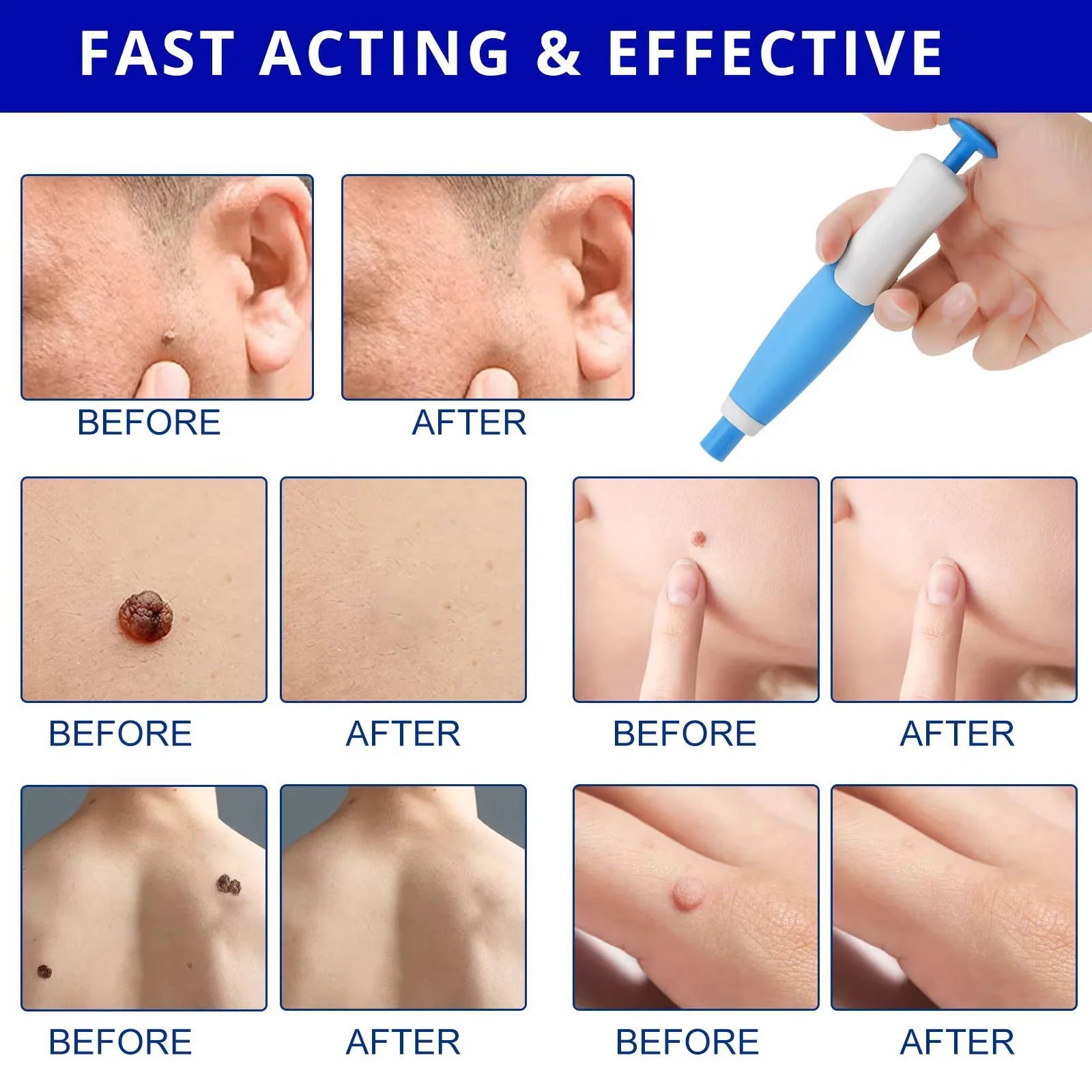 2-in-1 painless skin tag, mole, and wart removal device with blue and white applicator for effective home skin care.