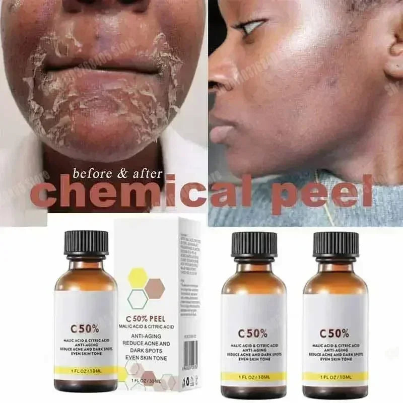 Salicylic Acid Peeling Lotion for Dark Skin | Professional Exfoliation Scrubs Treatments Tidesmit