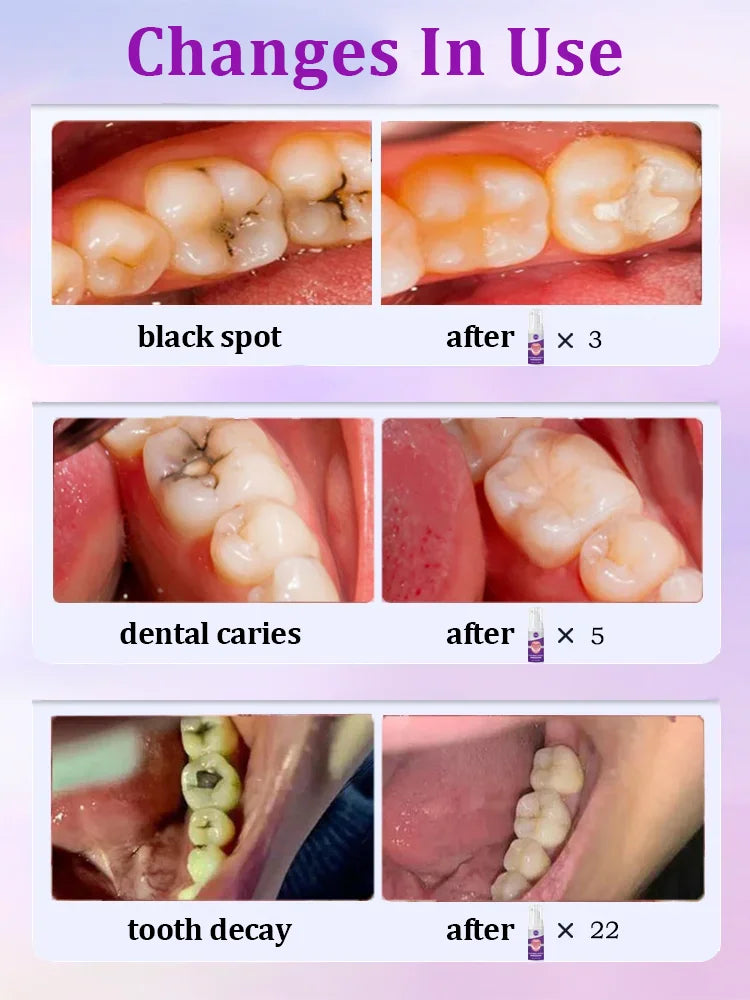 Tidesmit anti-caries teeth whitening gel for cavity repair and enamel remineralization