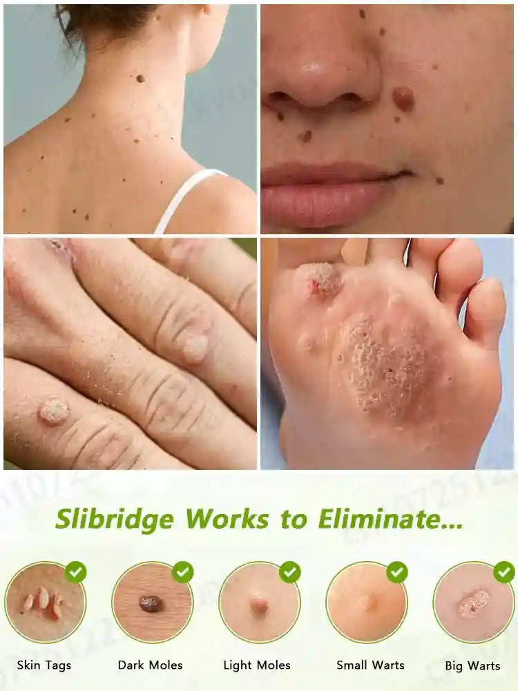 Wart Removal Pen | Painless Skin Tag Laser Device | Tidesmit (1pc/2pc) Relaxation Treatment Tidesmit