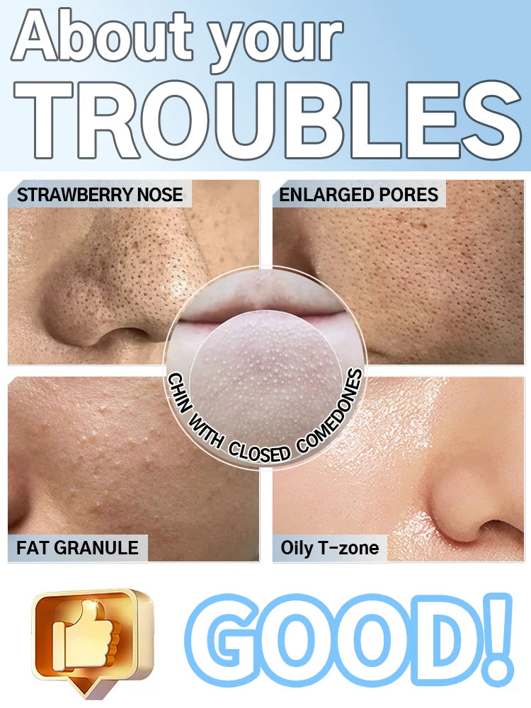 Skin issues treated by electric blackhead vacuum: strawberry nose, enlarged pores, acne, oily T-zone, and fat granules.