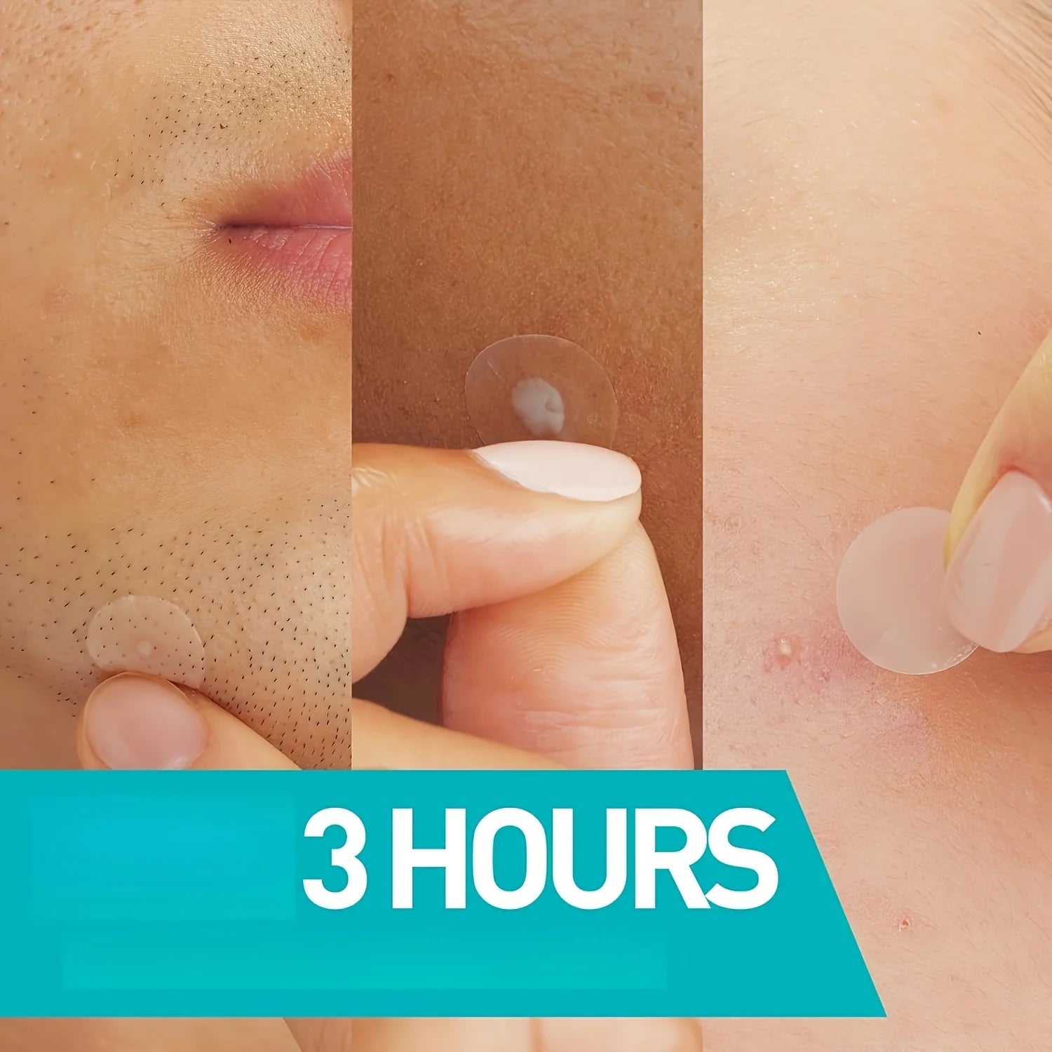 24PCSHydrocolloid acne patches,hydrocolloid invisible patch, mild formula,,which will help with better acne removal