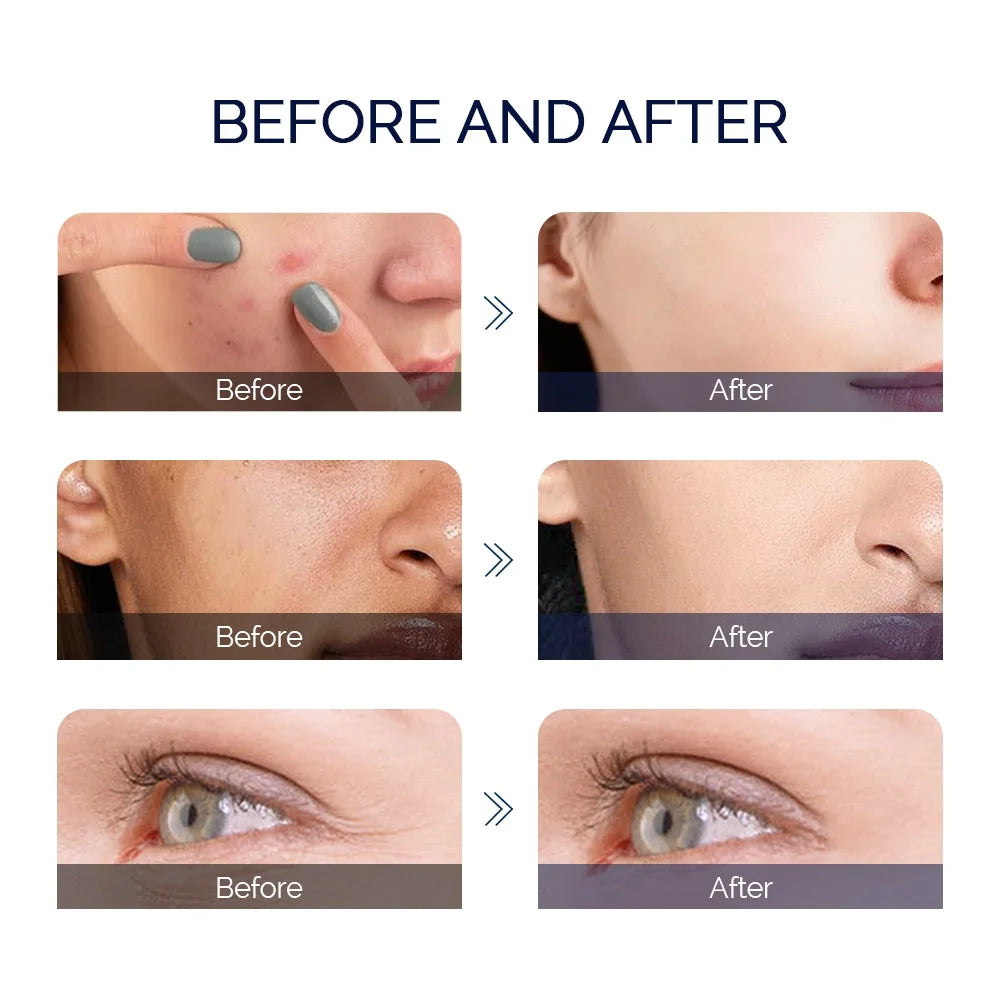 Before and after comparison of skin showing reduced acne, smoothed texture, and diminished fine lines under the eye.