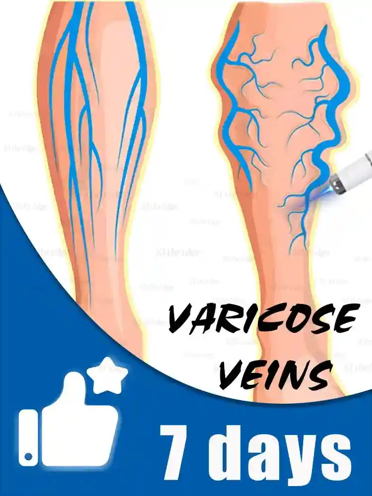 A blue light pen treating visible leg veins on an illustration of two human lower legs.