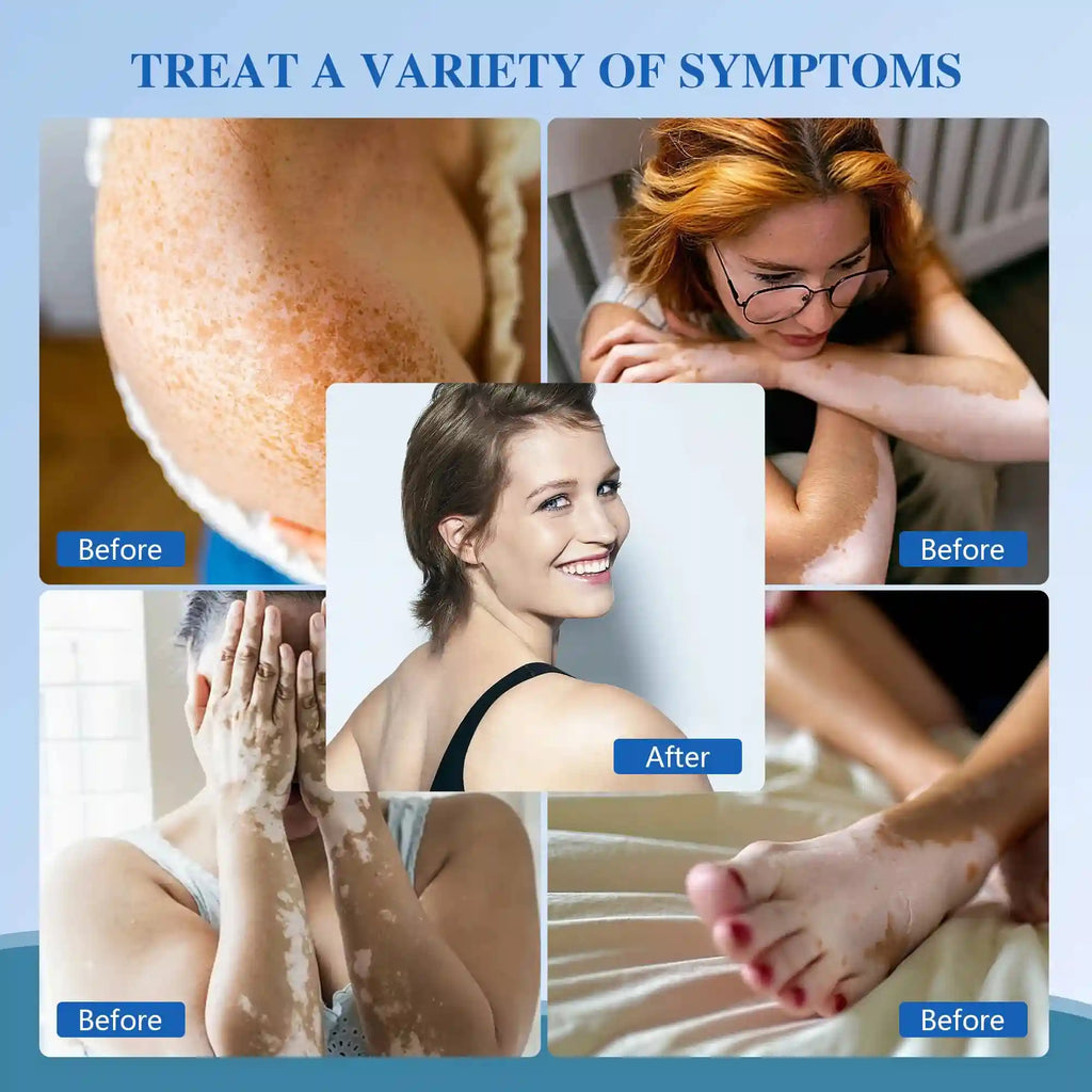 Collage showing skin pigmentation treatment results, with before-and-after photos of vitiligo and skin discoloration.
