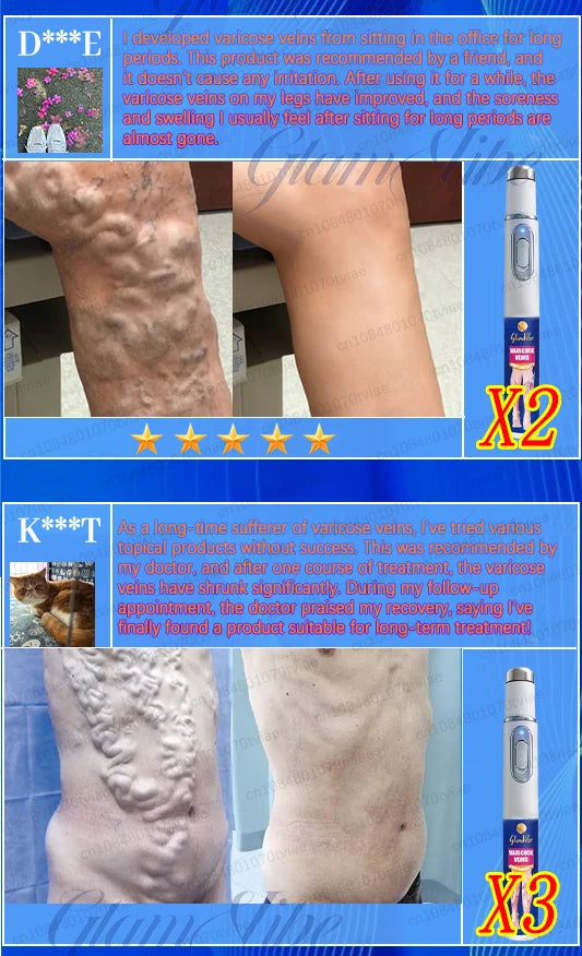 Blue Light Pen for Leg Health - Portable Wellness Therapy Device Relaxation Treatment Tidesmit