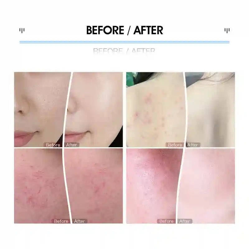 Before and after results showing improved skin texture, acne, and redness using 7-color LED light therapy mask.