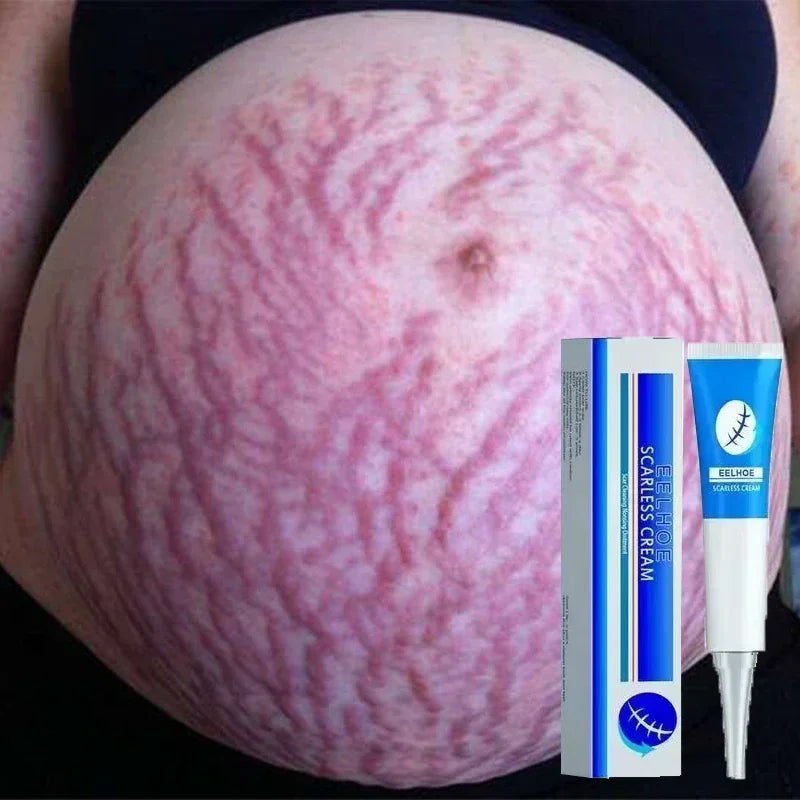 Stretch Mark Repair Cream for Pregnancy Postpartum Skin Recovery Relaxation Treatment Tidesmit