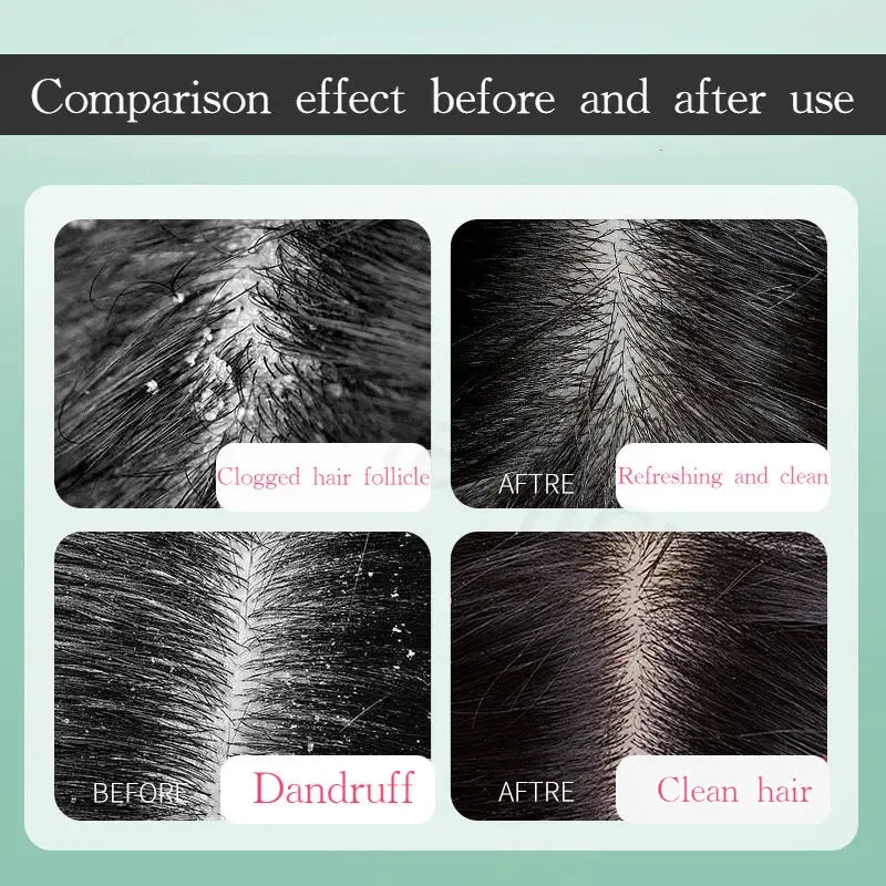Anti Dandruff Scalp Scrub Treatment for Itch Relief - Tidesmit Scrubs Treatments Tidesmit