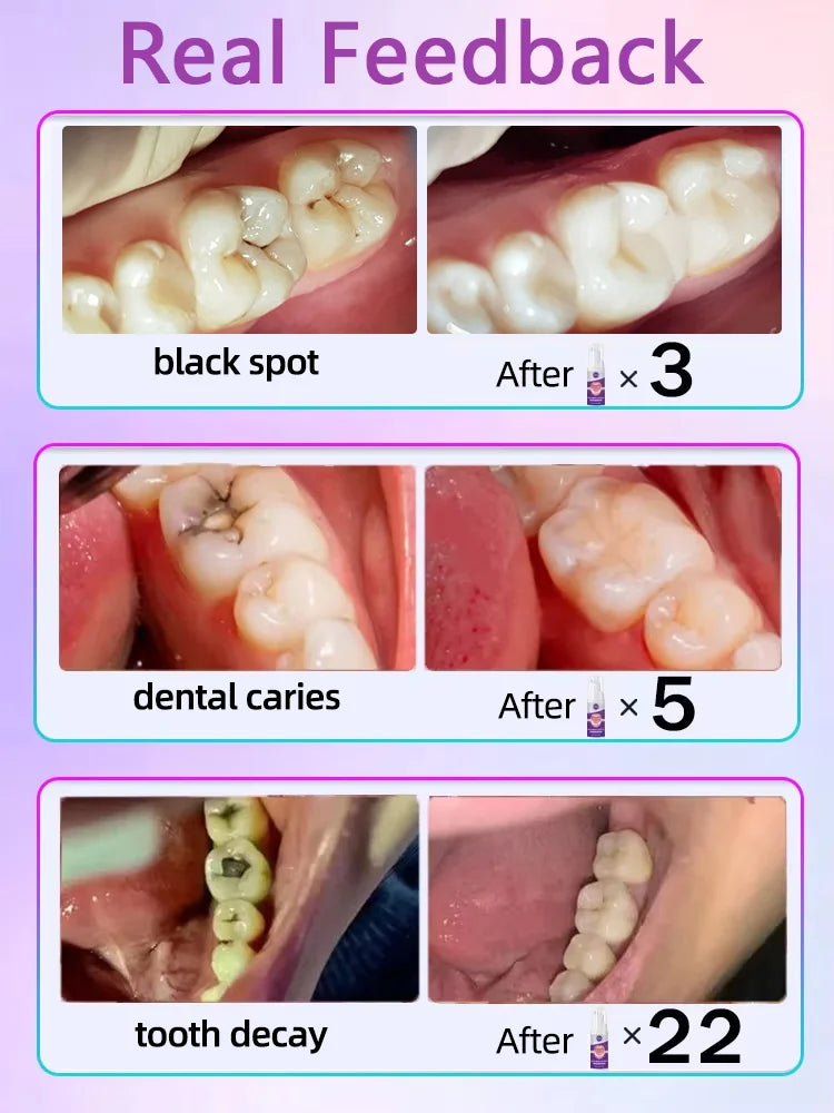 Tidesmit cavity repair cream for tooth decay treatment and teeth whitening