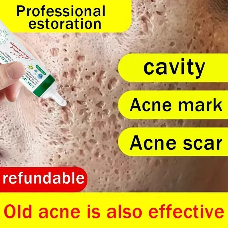 Acne Scar Removal Gel for Men – Professional Pothole Mark Repair Scrubs Treatments Tidesmit