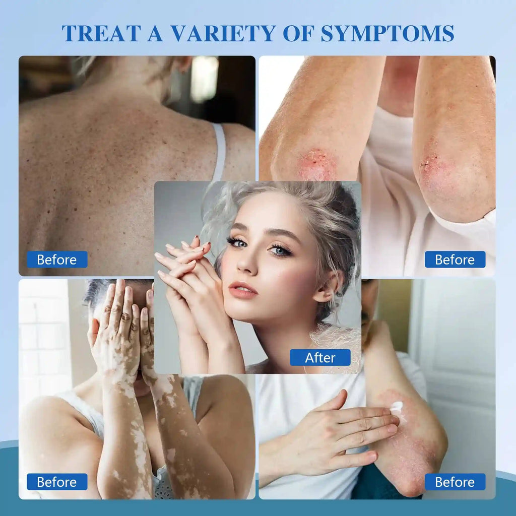 Collage showing skin treatments for psoriasis, vitiligo, and eczema with before and after results on the body and face.