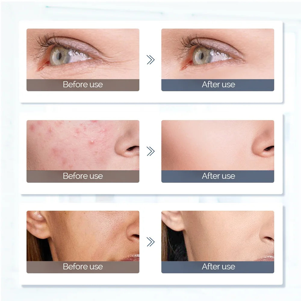 Before and after comparison showing improved skin texture, reduced acne, and fewer wrinkles after LED light therapy.