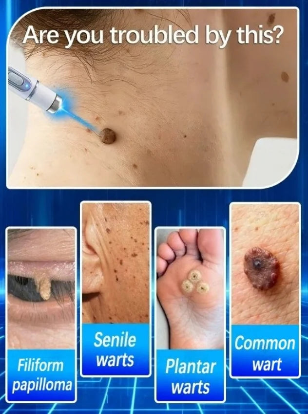 Wart Remover Blue Light Device: Painless Skin Tag Treatment Scrubs Treatments Tidesmit