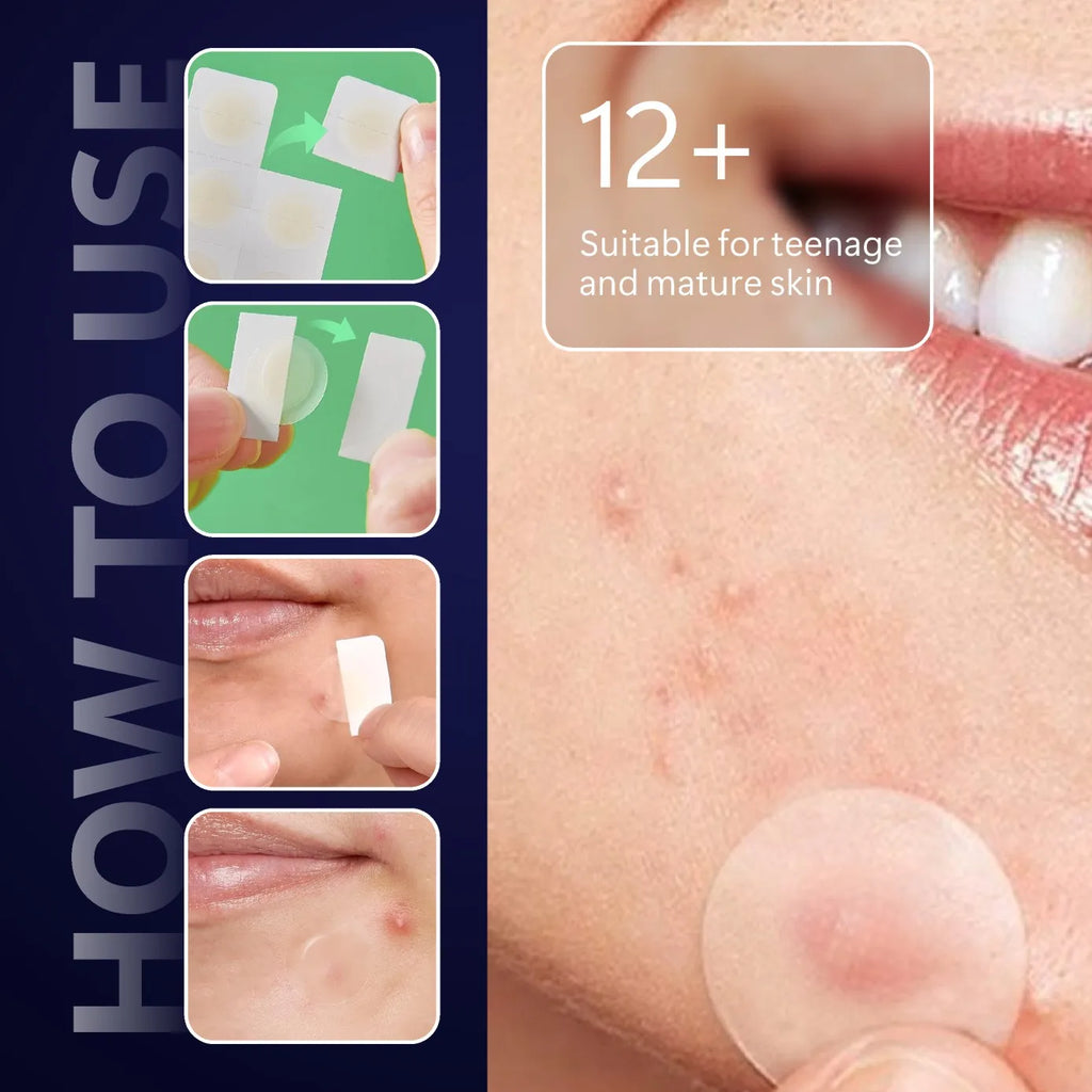 Microneedle acne patch, used to cover blemishes and conceal acne. The microneedles are shorter than 3 millimeters.
