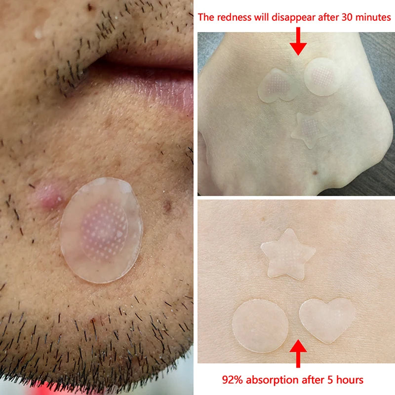 Salicylic AcidRemoval Acne Stickers Microneedle Blemish Treatment Facial Healing Treatment Skin Care Patch Tools Water-Soluble