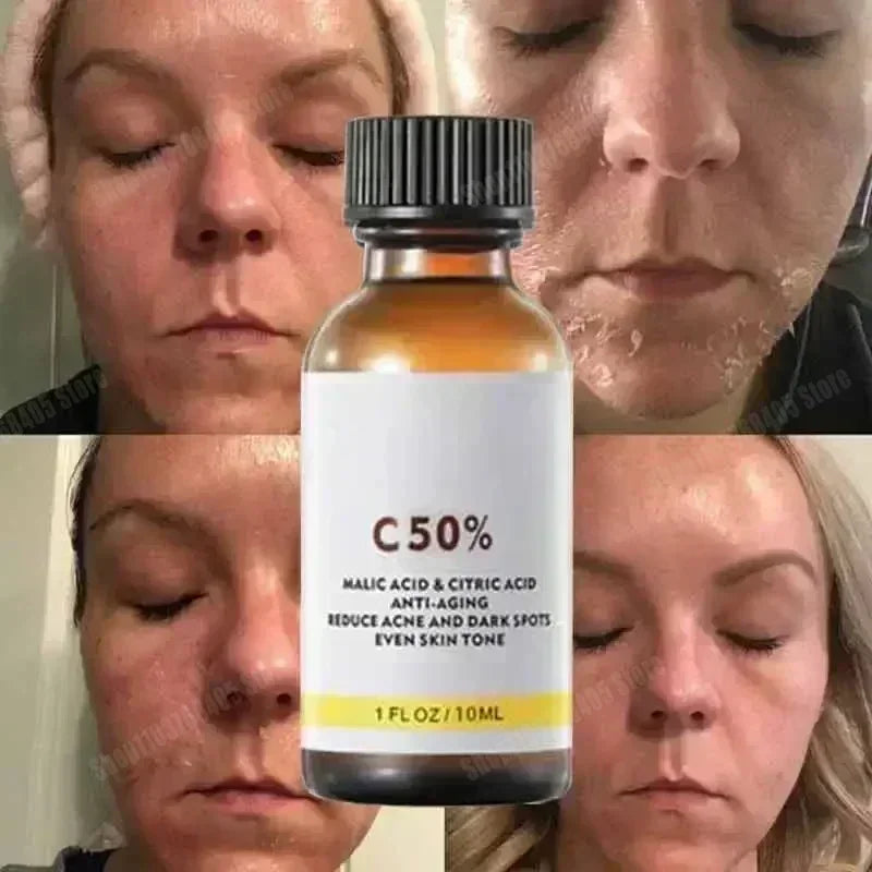 Salicylic Acid Face Peel - Salon-Quality Exfoliating Acne Treatment Scrubs Treatments Tidesmit