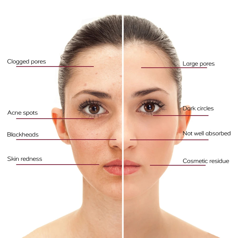 Before and after results for plasma pen mole, freckle, and dark spot removal on a woman's face showing skin improvement.
