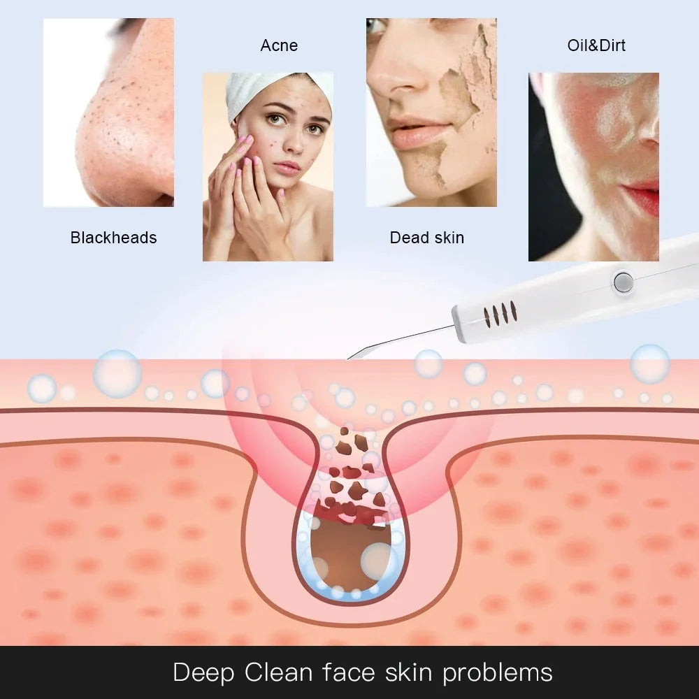 Ultrasonic Skin Scrubber Facial Cleanser - Professional Pore Exfoliator Scrubs Treatments Tidesmit