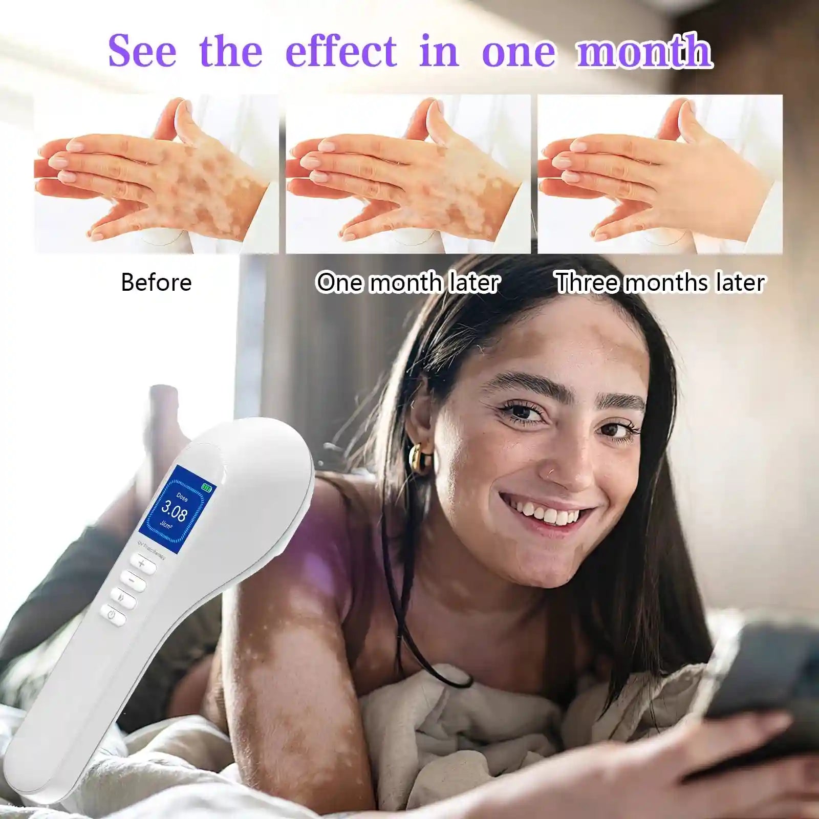 Handheld white UV phototherapy device for skin condition treatment with a digital display and control buttons.