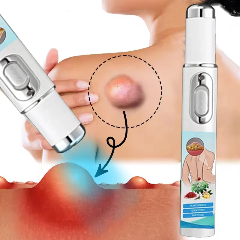 Lipoma Removal Laser Device for Subcutaneous Lumps - Tidesmit Lip Care Tidesmit