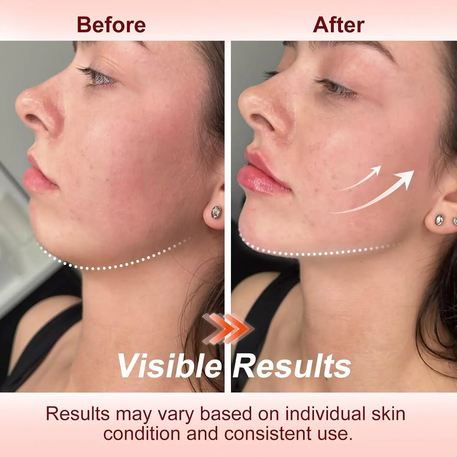 Before and after comparison of a person's jawline showing skin firming results from a microcurrent facial device.