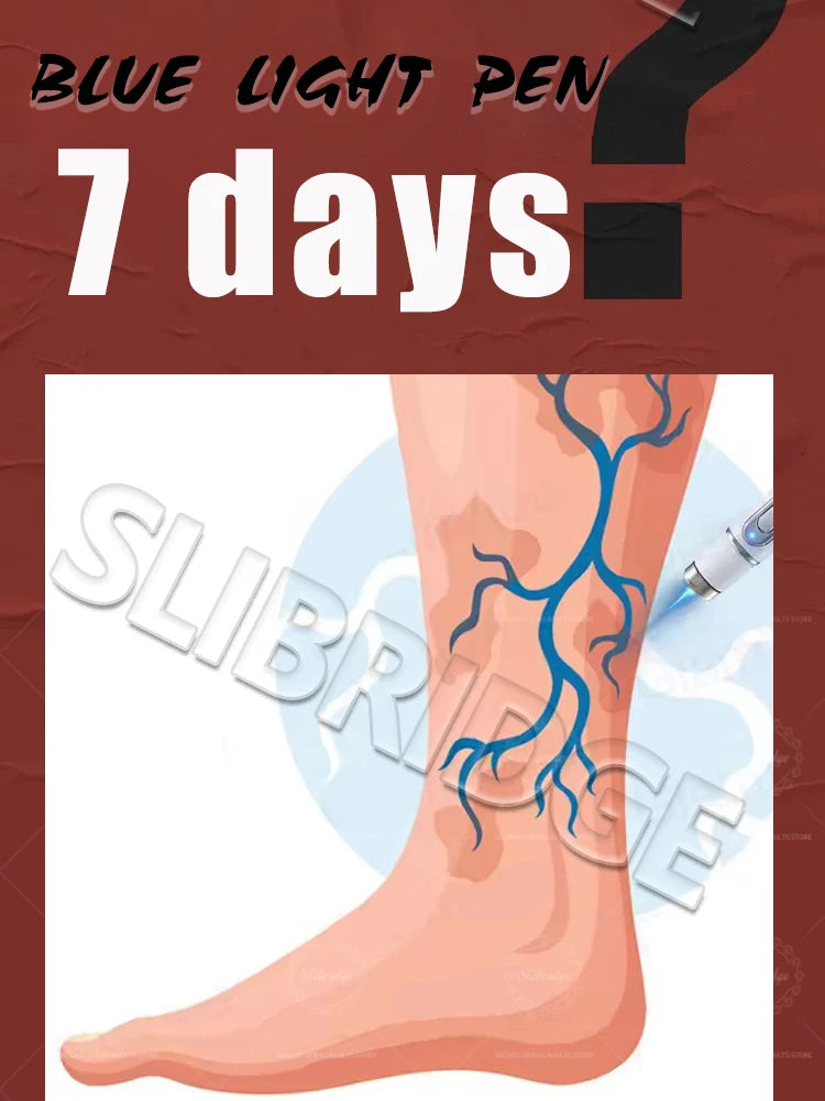 A blue light vein therapy pen treating visible leg veins in a medical illustration with "7 days" text overlay.