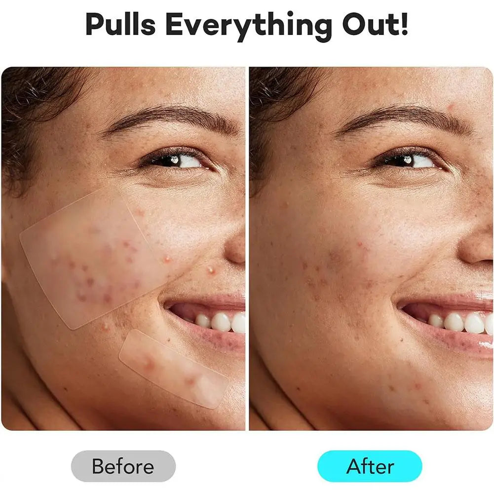 200/262/360pcs Salicylic Acid Acne Patches Mild Non-irritating Fade Black Acne Marks Facial Care Patches Acne Closure Removal