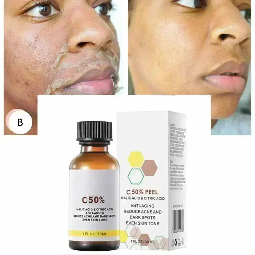 Salicylic Acid Face Peel - Professional Deep Exfoliation & Skin Refinement Scrubs Treatments Tidesmit