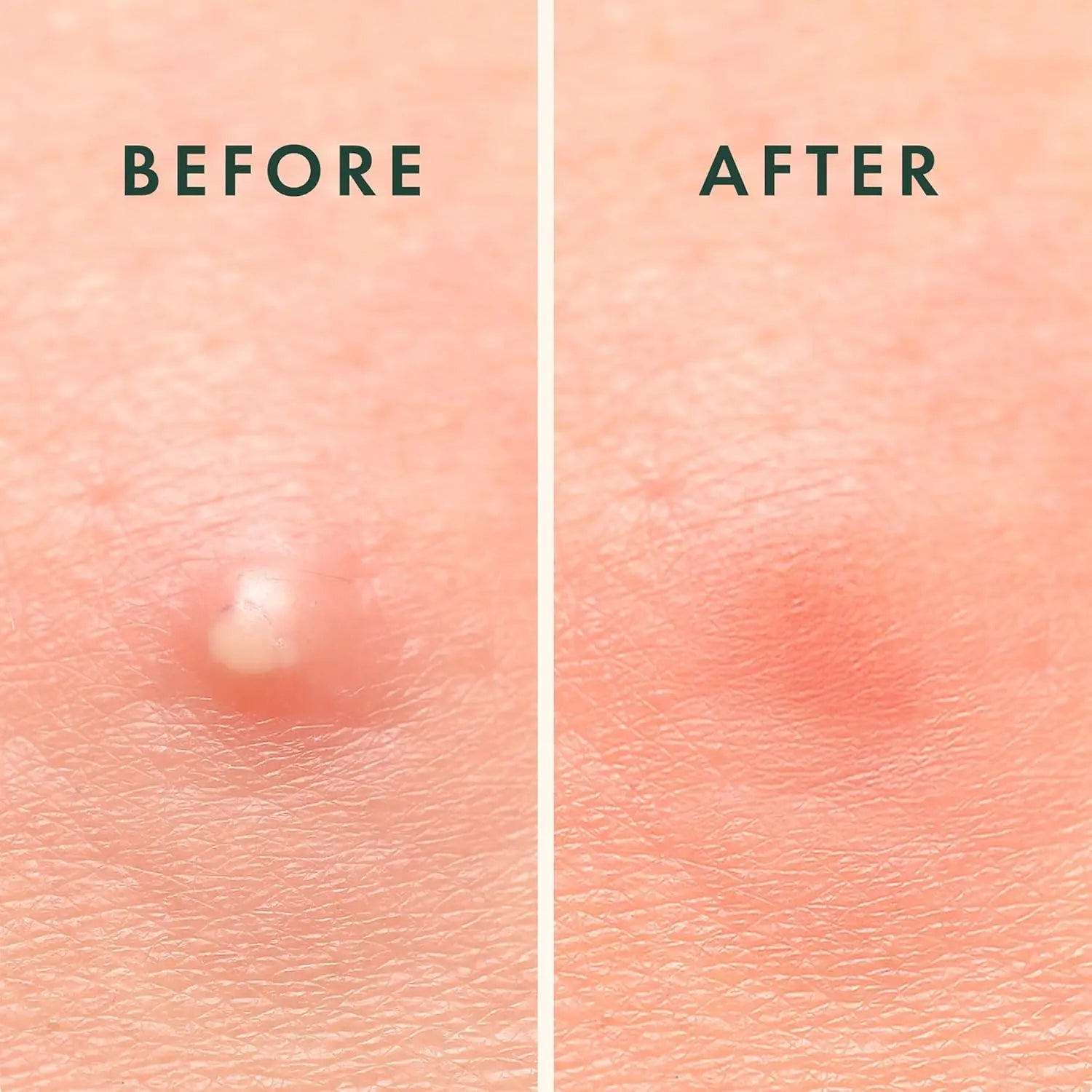 Hydrocolloid Acne Pimple Patches for Face Shrinking Zits Whiteheads Nighttime Spot Pimple Stickers for Face Skin Care Tools