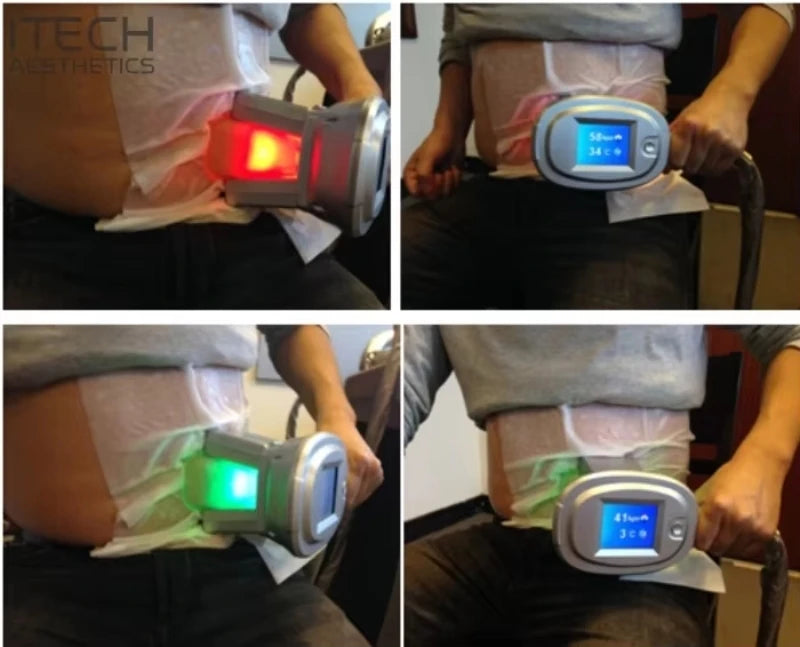 Cryolipolysis Antifreeze Membrane Pads - Skin Protection for Coolsculpting Fascia Gun Tidesmit