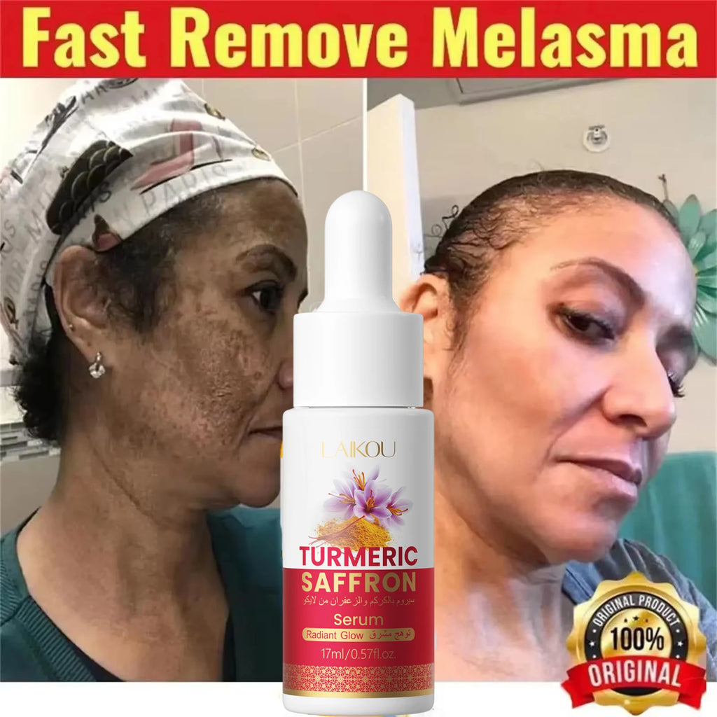 Turmeric Freckle Removing Whitening Essence Fade Pigmentation Melasma Dark Spots Corrector Repair Serum Korean Skin Care