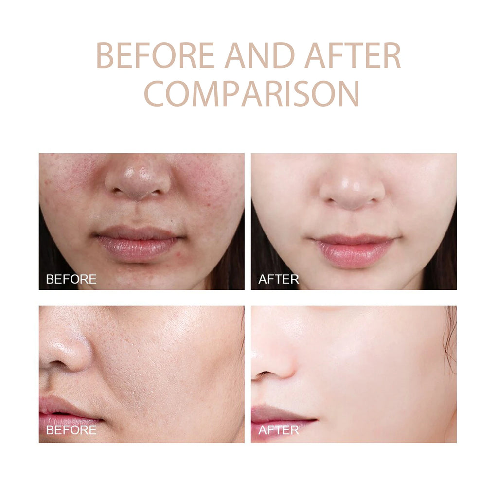 Exfoliating Gel for Pore Cleansing & Acne - 50g Salon-Quality Treatment Scrubs Treatments Tidesmit