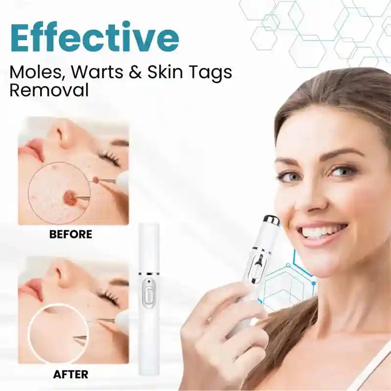 Blue Light Skin Tag & Wart Removal Pen | Precision Wellness Tool Back Massage Instrument Tidesmit