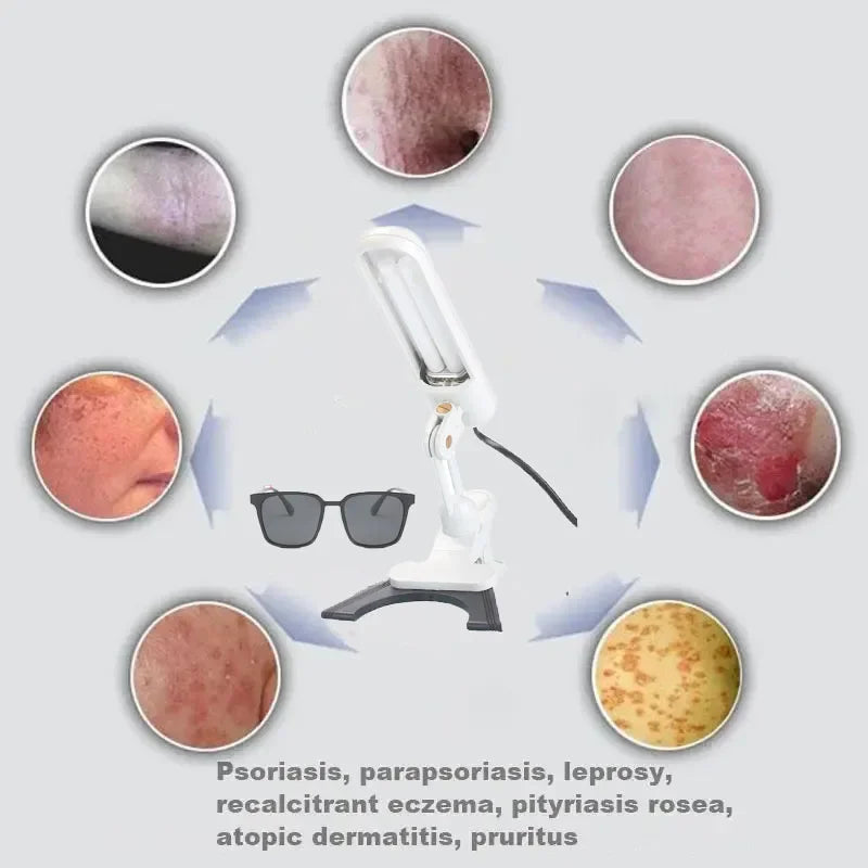 White handheld 311nm UVB light therapy lamp for treating psoriasis, vitiligo, and eczema with protective goggles.