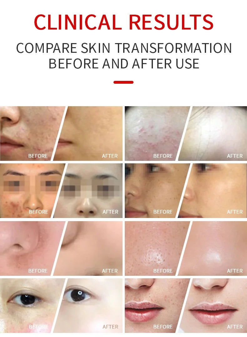 Before and after clinical results of 7-color LED light therapy mask for skin rejuvenation and acne treatment.