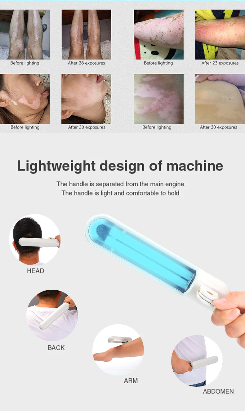 Portable 311nm handheld UVB lamp for vitiligo, psoriasis, and eczema treatment with before-and-after results.
