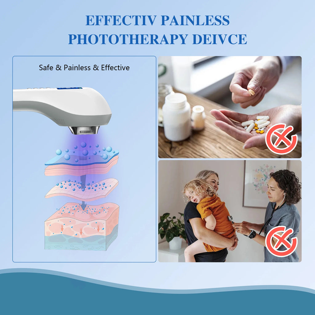 White handheld phototherapy device emitting blue light into skin layers as an alternative to oral medication.