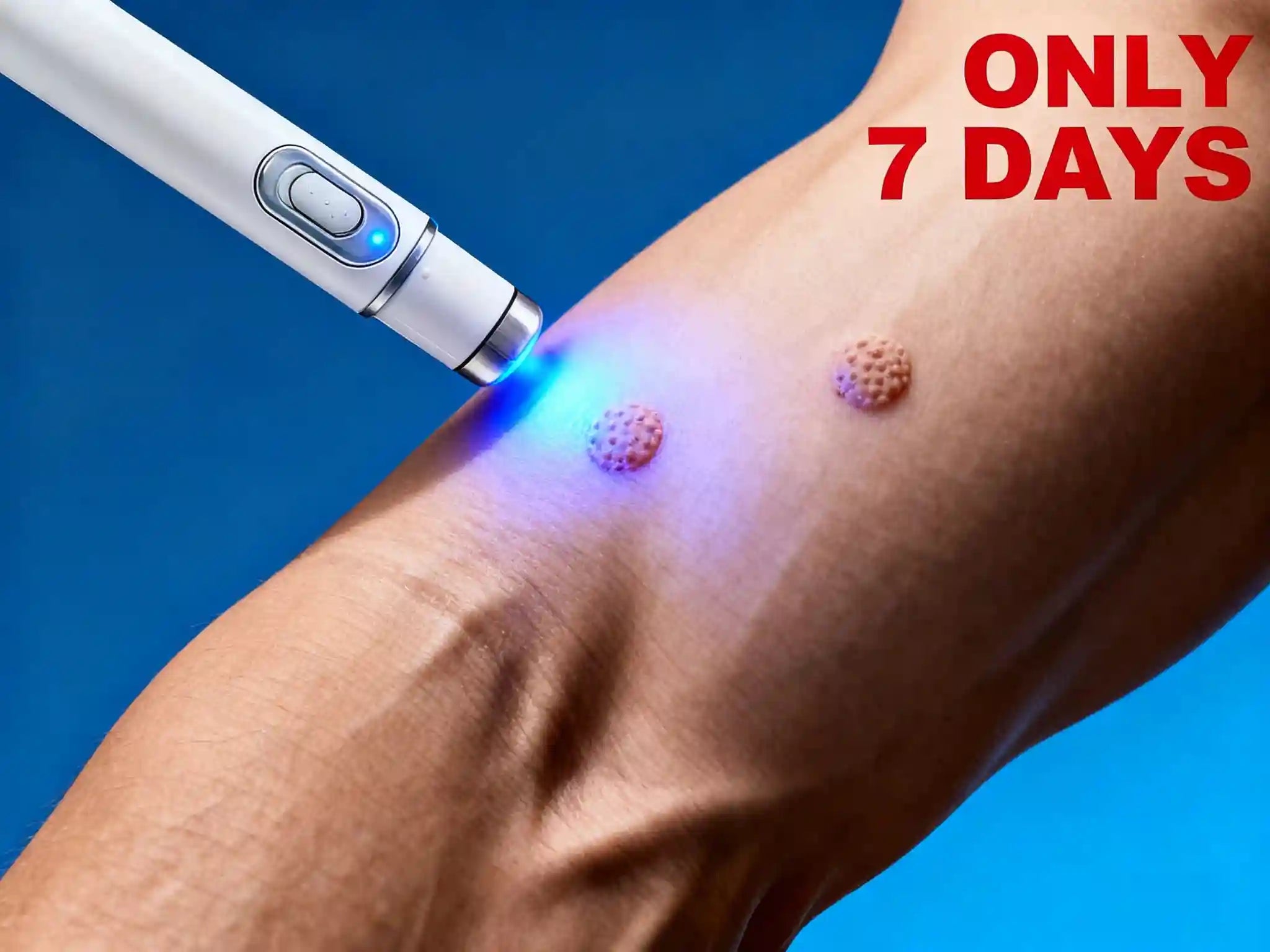 Blue Light Wart Removal Pen | Precision Skin Care Tool | Tidesmit Lip Care Buy 3 get 2 Free Tidesmit