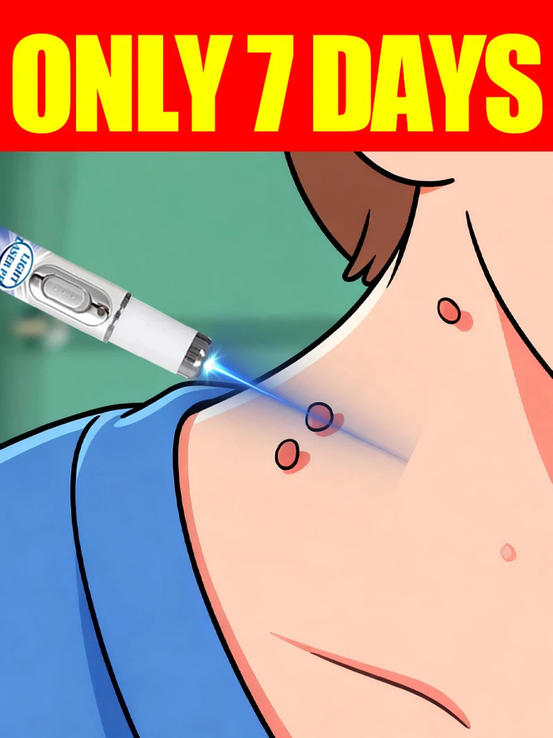 Illustration of a white blue-light laser pen treating skin tags or warts on a person's neck.