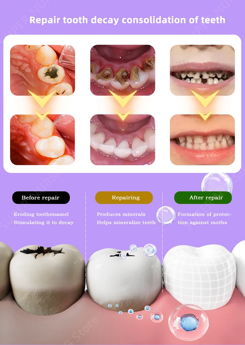 Tidesmit anti-caries teeth whitening treatment for healing cavities and enamel repair