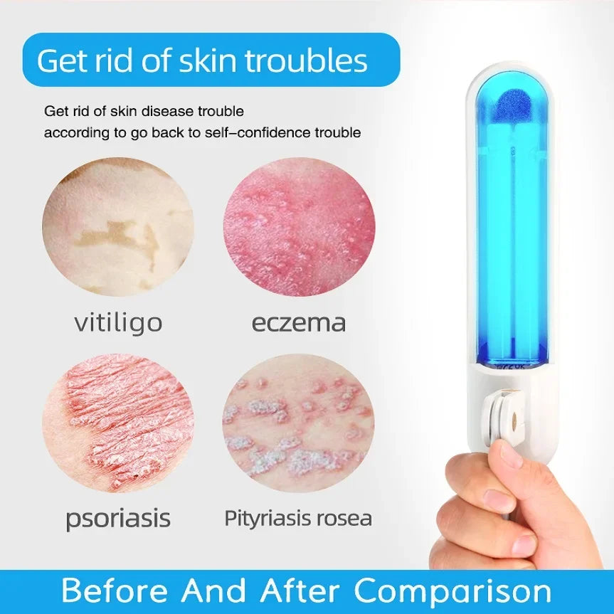 Handheld UV phototherapy lamp with a white handle and blue light tube, used for treating psoriasis and eczema.