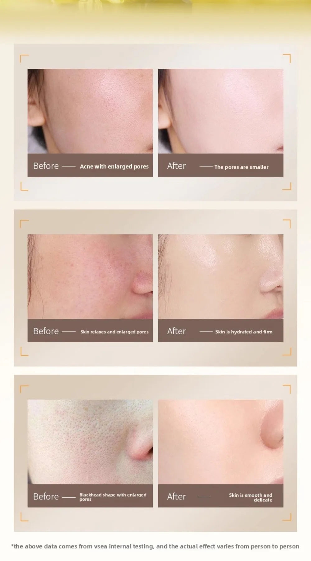 Comparison of skin before and after treatment, showing reduction in acne, enlarged pores, and improved skin hydration.