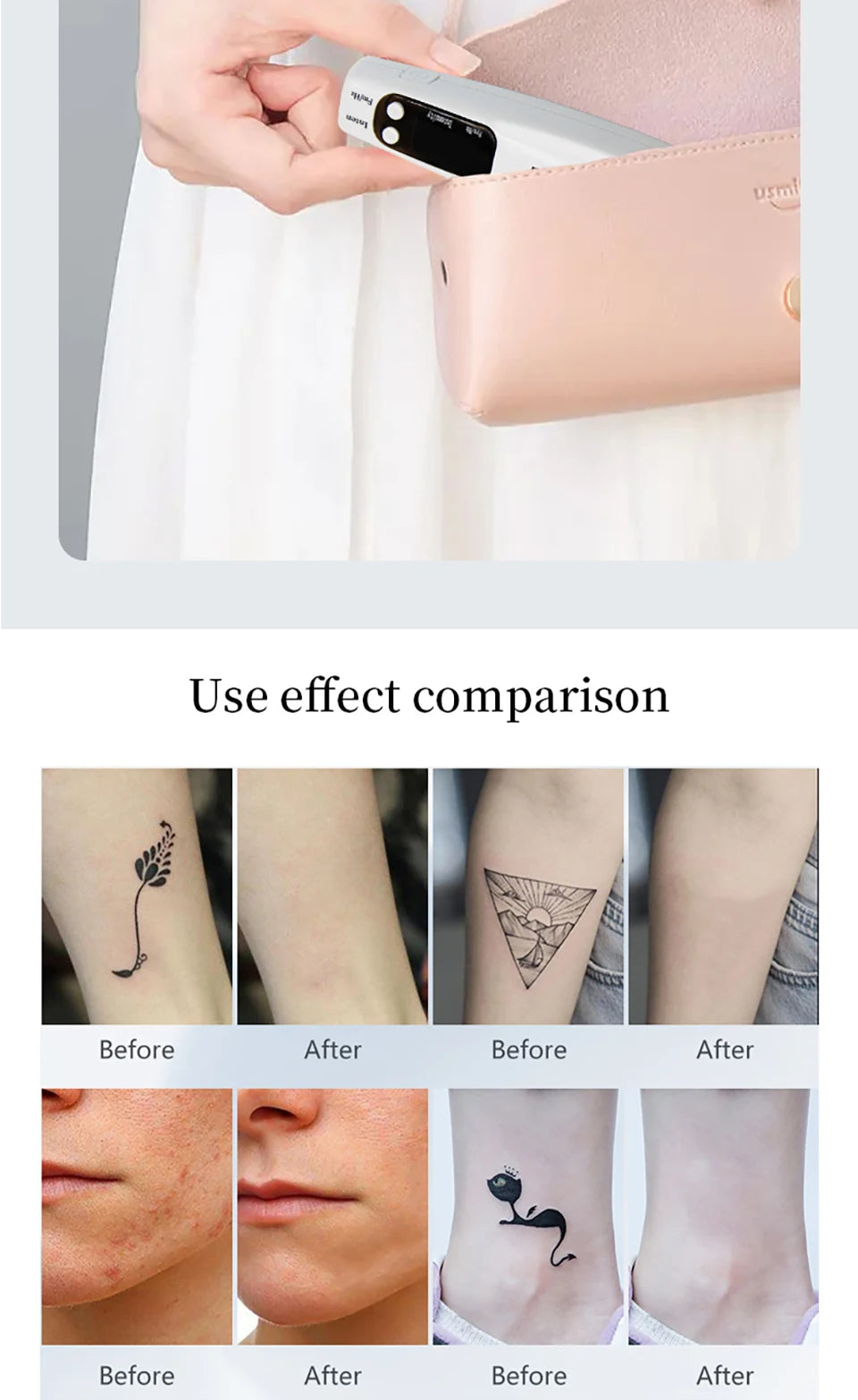 Portable picosecond laser pen for tattoo, acne, and dark spot removal with before and after skin treatment results.