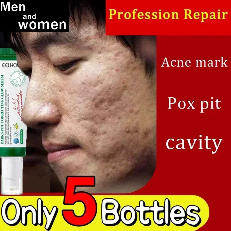 Acne Scar Removal Cream for Pore Repair & Skin Texture - Tidesmit Scrubs Treatments Tidesmit