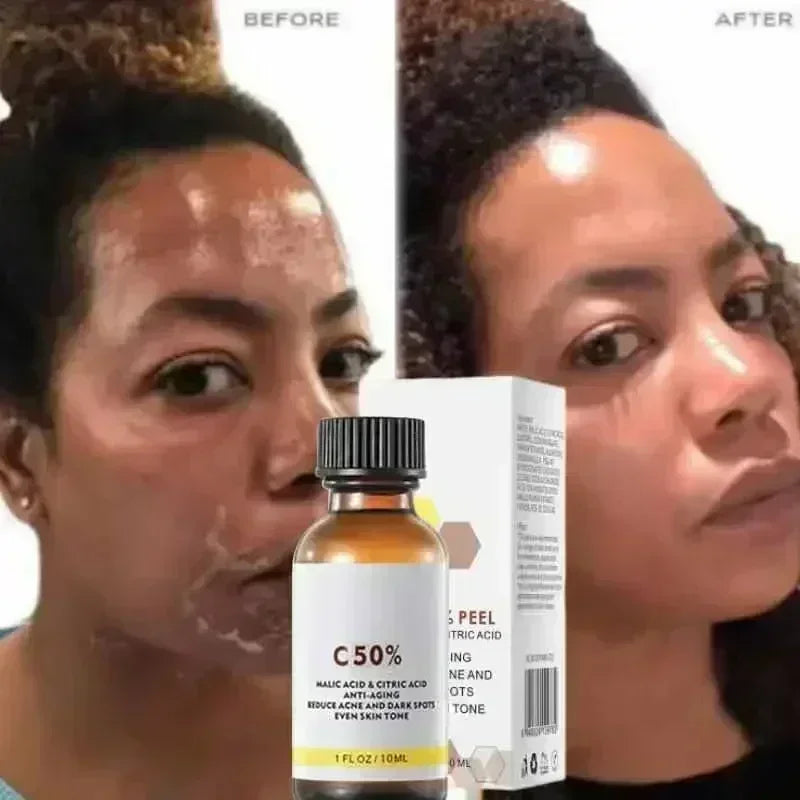 Salicylic Acid Peeling Lotion for Dark Skin | Professional Exfoliation Scrubs Treatments Tidesmit